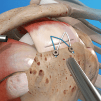 Arthroscopic Rotator Cuff Repair