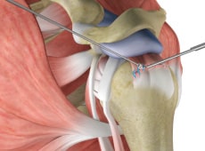 Arthroscopic Rotator Cuff Repair