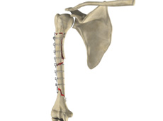 Complex Fracture Repair