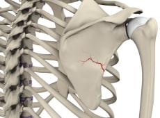 Fracture of the Shoulder Blade