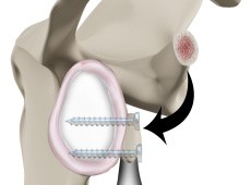 Latarjet Procedure