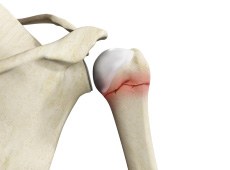 Proximal Humerus Fractures