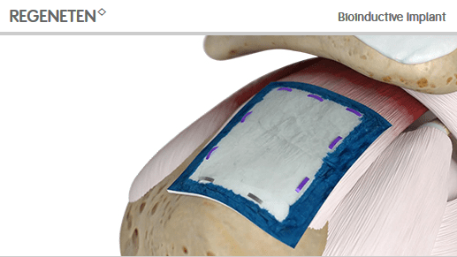 REGENETEN Bioinductive Implant