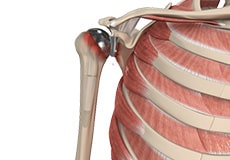 Revision Shoulder Replacement