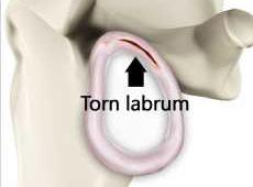 Glenoid Labrum Tears